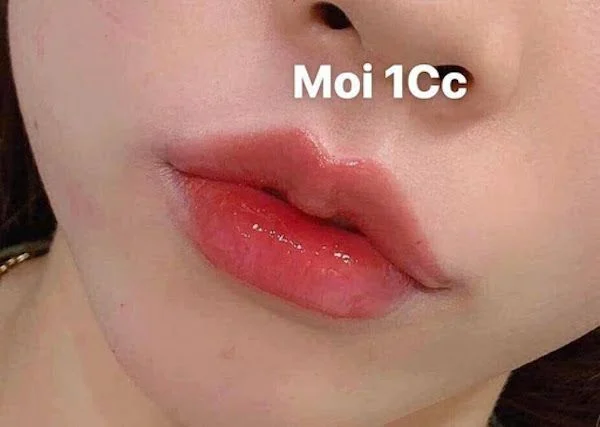 địa chỉ tiêm môi hcm