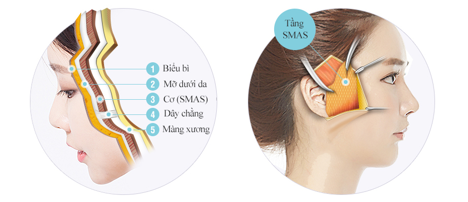 Căng da mặt smas tphcm