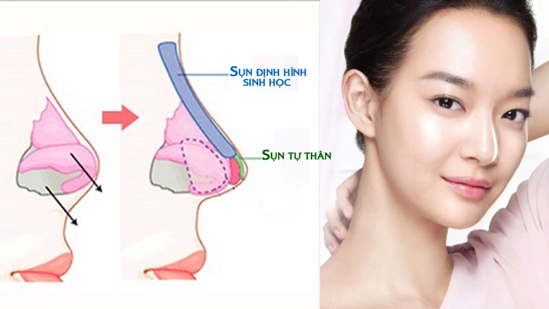 Chi phí nâng mũi ở Anh, Đức, Pháp, Ý, Ba Lan, Thổ Nhỉ Kỳ