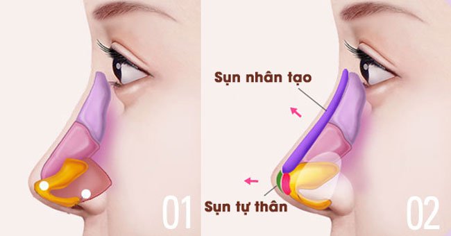 Chi phí nâng mũi ở Anh, Đức, Pháp, Ý, Ba Lan, Thổ Nhỉ Kỳ