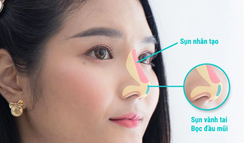 Chi phí nâng mũi ở Anh, Đức, Pháp, Ý, Ba Lan, Thổ Nhỉ Kỳ