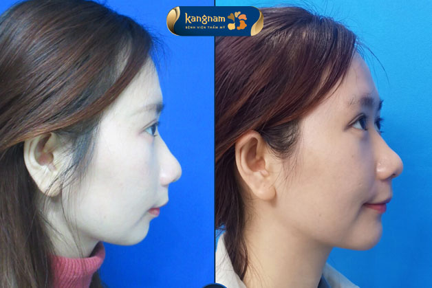 độn cằm hcm