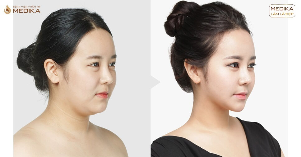 độn cằm tphcm