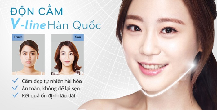 độn cằm tphcm