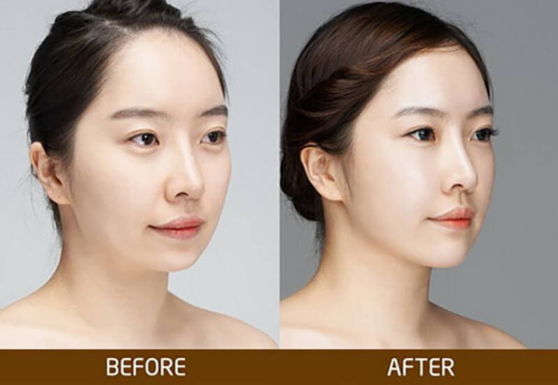 độn cằm tphcm