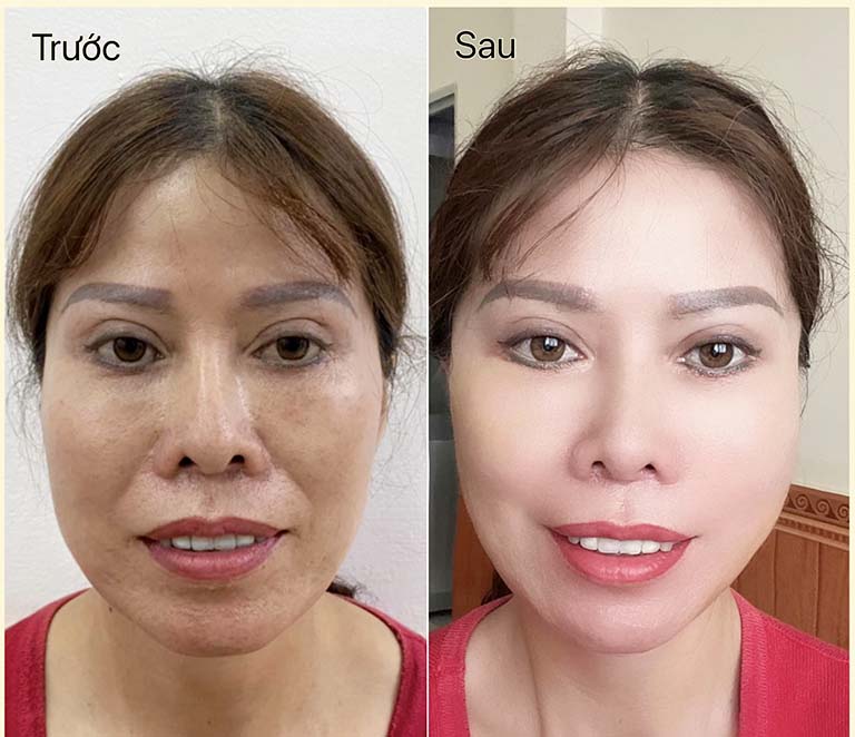 xóa rãnh cười hcm