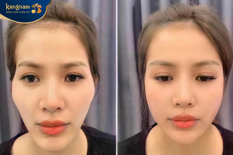 tiêm filler xóa rãnh cười hcm