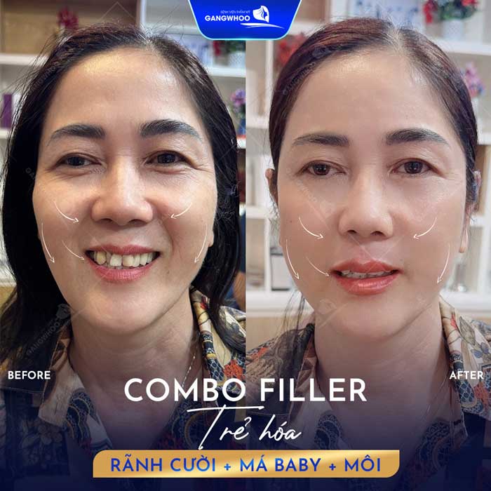 Xóa rãnh cười ở đâu uy tín tphcm