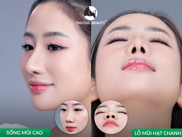 nâng mũi s line hcm