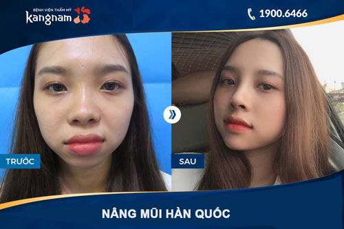 nâng mũi s line tphcm