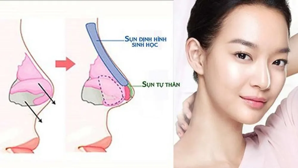 nâng mũi tự nhiên hcm