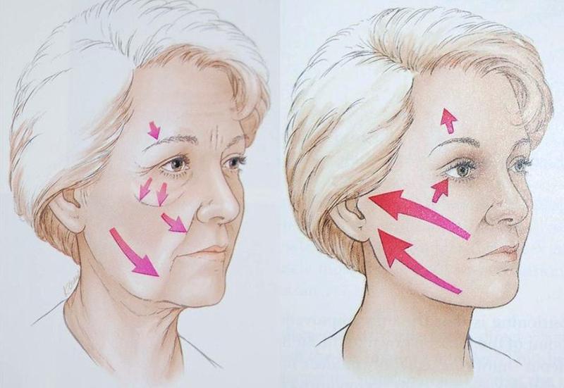 Căng da mặt bằng công nghệ HIFU TPHCM