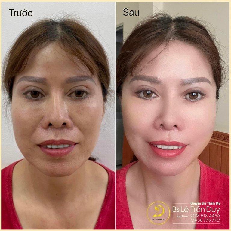 Căng da mặt bằng công nghệ PRP TPHCM