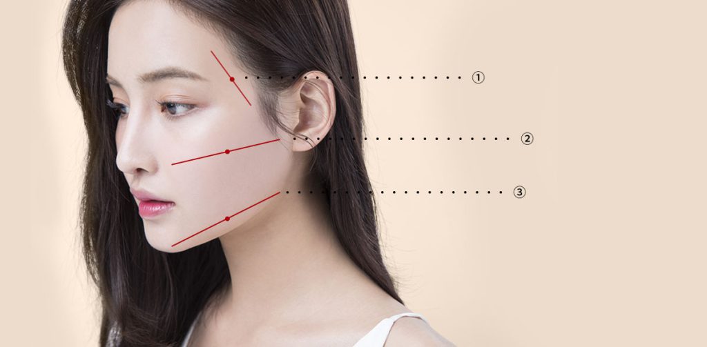 Căng da mặt kendall HCM