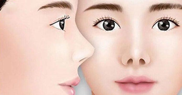 chỉnh sửa mũi hếch hcm