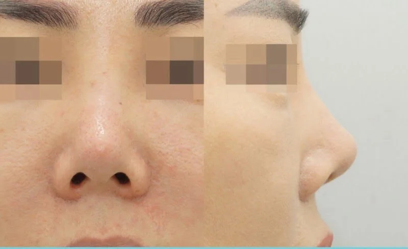 chỉnh sửa mũi hếch tphcm