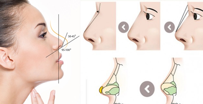 nâng mũi dựng trụ hcm