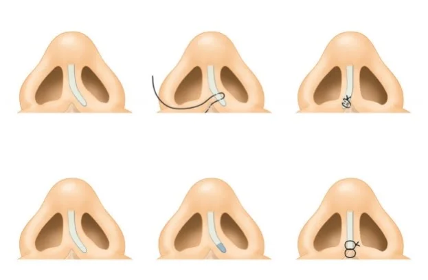 nâng mũi dựng trụ tphcm