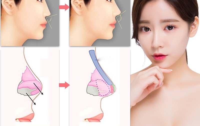 nâng mũi mổ hở tphcm