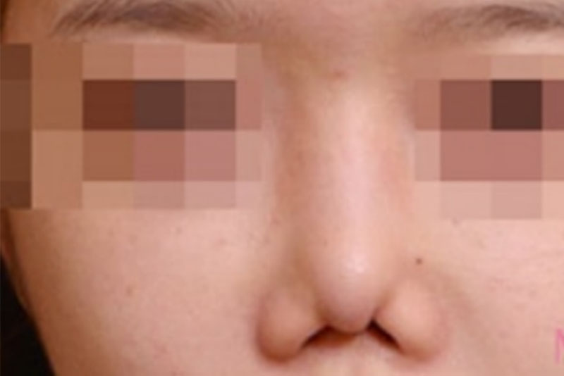 TOP 5 Bác sĩ Nâng mũi cho trường hợp mũi dị tật ở TP.HCM