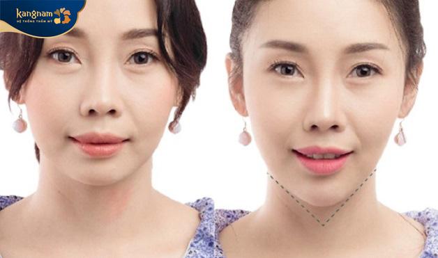 tiêm filler cằm ở đâu uy tín tại TPHCM