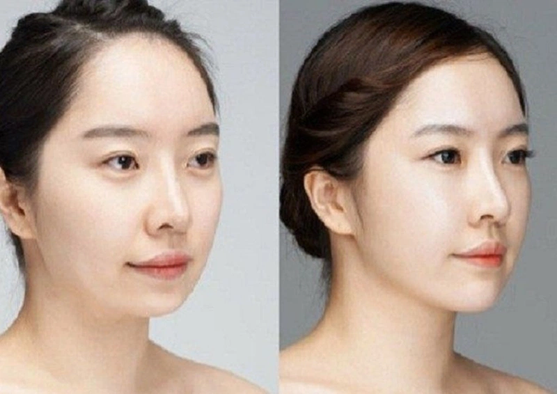 tiêm cằm tphcm