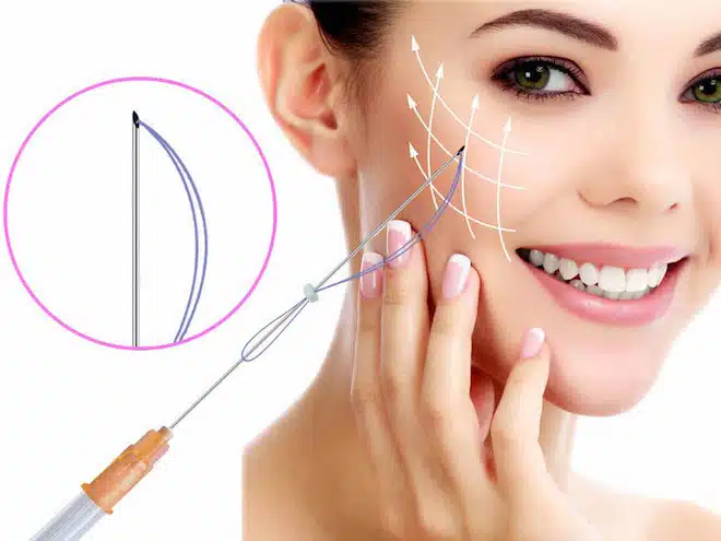 Căng da mặt Mesh Lift TPHCM