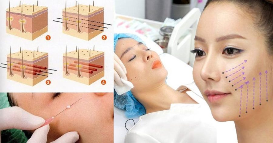 Căng da mặt Mesh Lift HCM