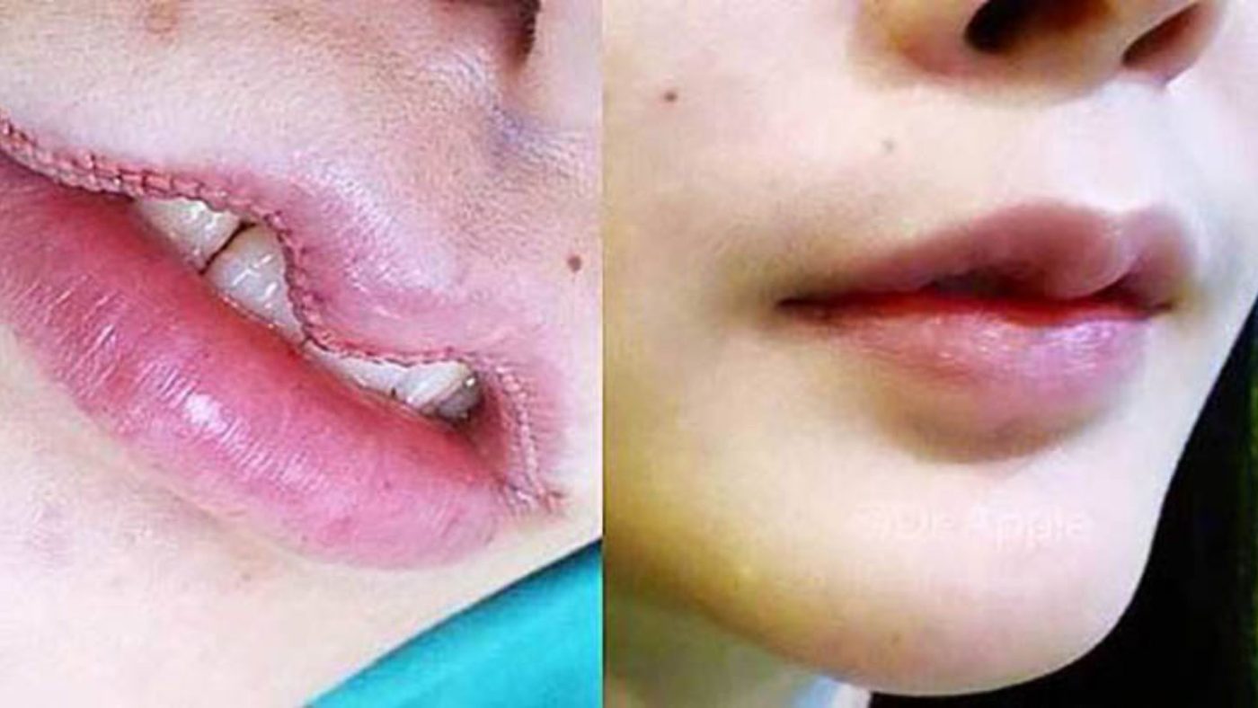 cắt môi trái tim hcm