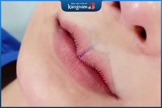 cắt môi trái tim tphcm