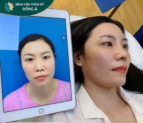 Nâng mũi sụn silicon tphcm