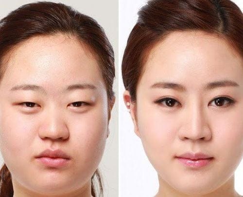 Cắt mí phượng hoàng hcm