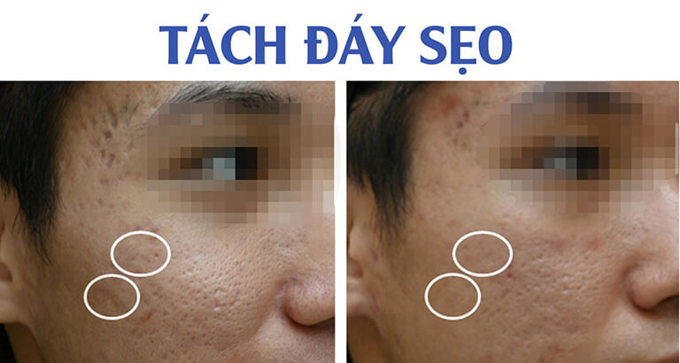 trị sẹo hcm