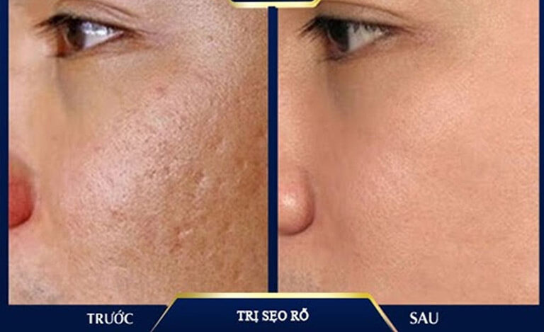 trị sẹo uy tín hcm