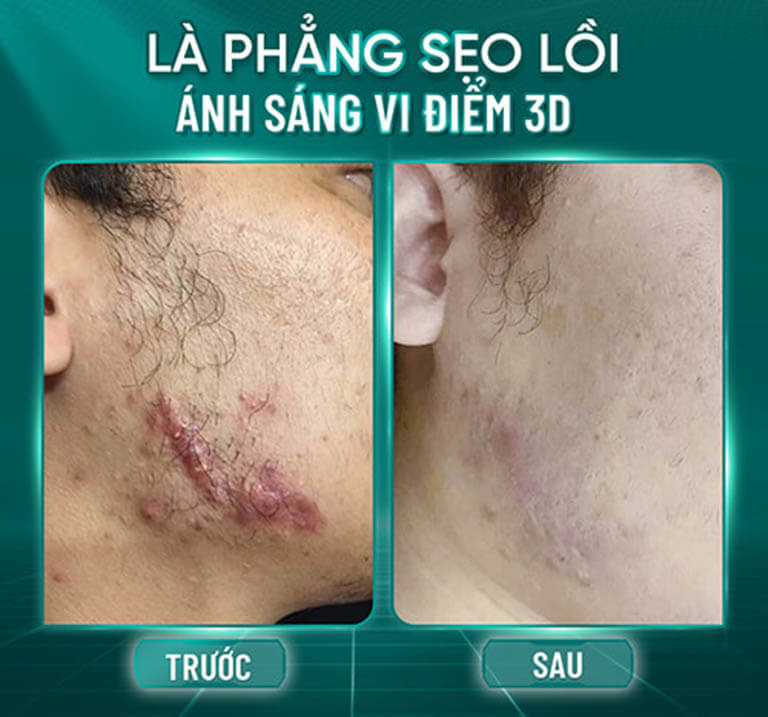 trị sẹo hiệu quả hcm