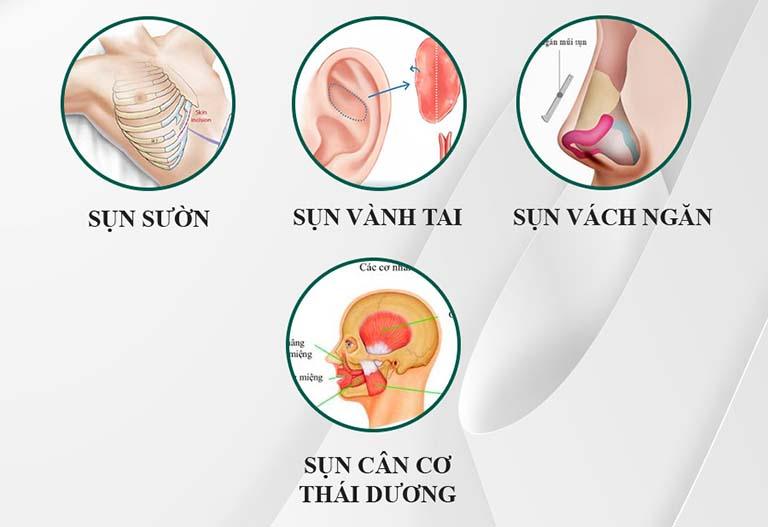 Nâng mũi bọc sụn cân cơ thái dương