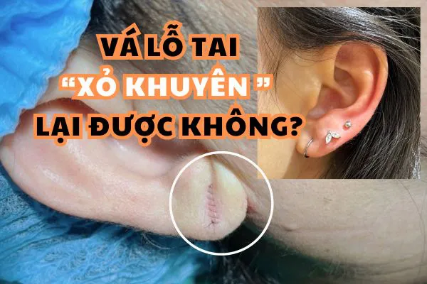 vá lỗ tai hcm