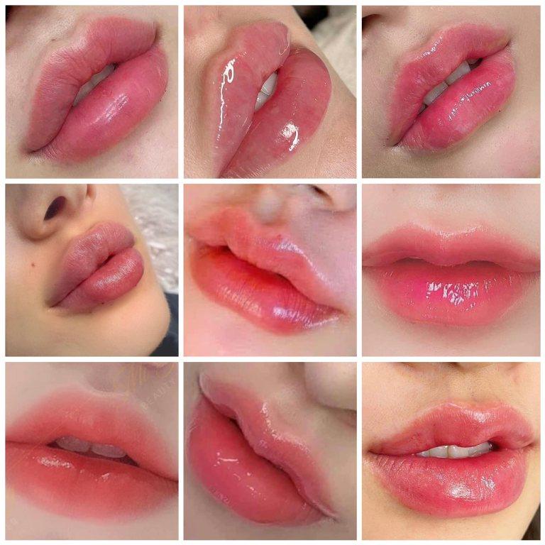 giá tiêm filler tphcm