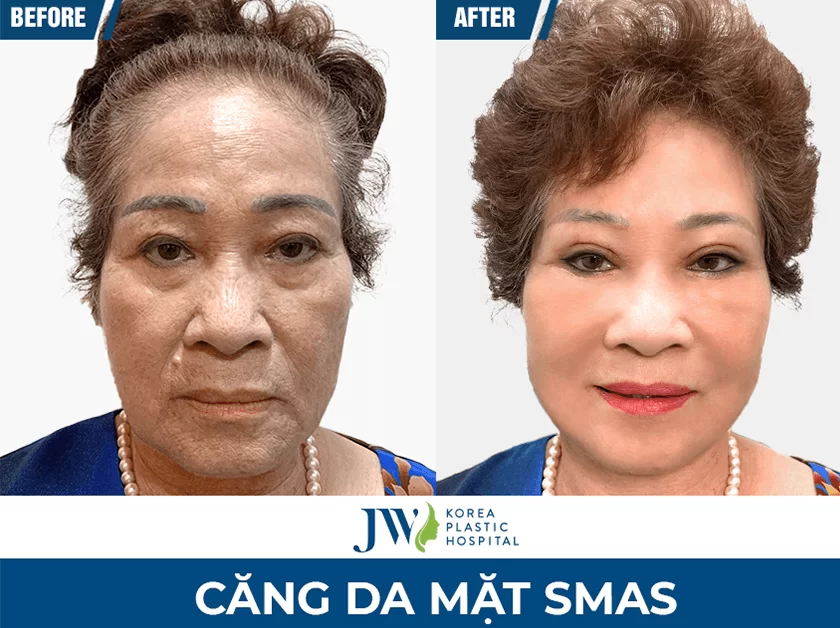 Bác sĩ căng da mặt giỏi hcm