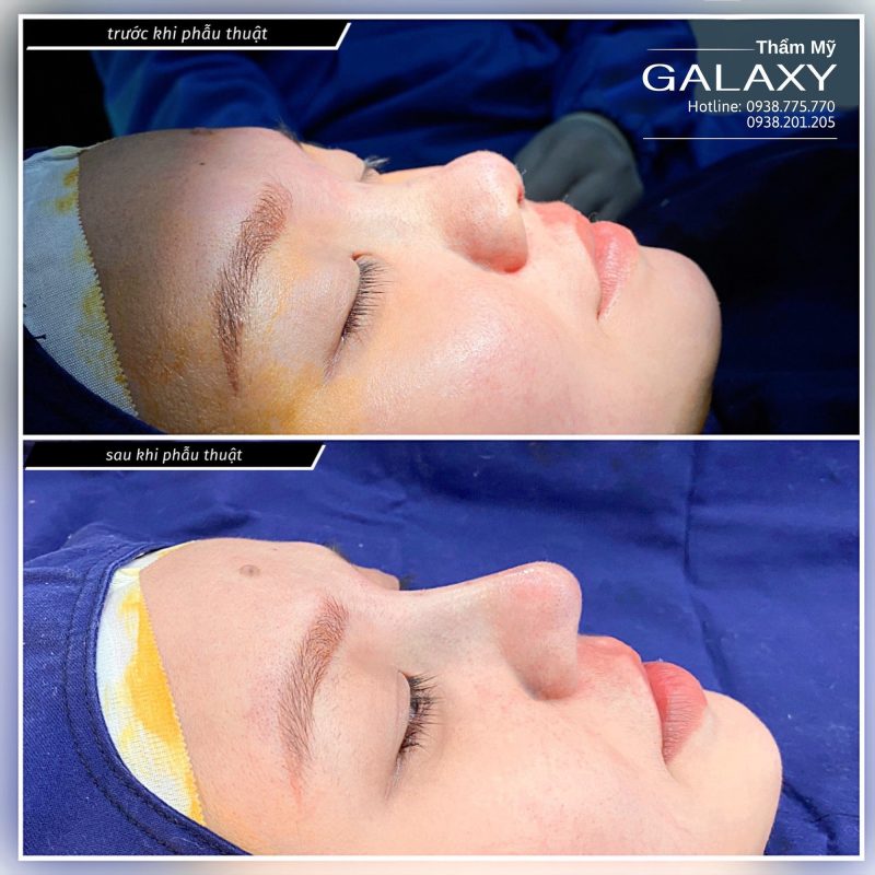 Nâng Mũi Miễn Phí Cho Học Sinh Nghèo Tại Bến Tre