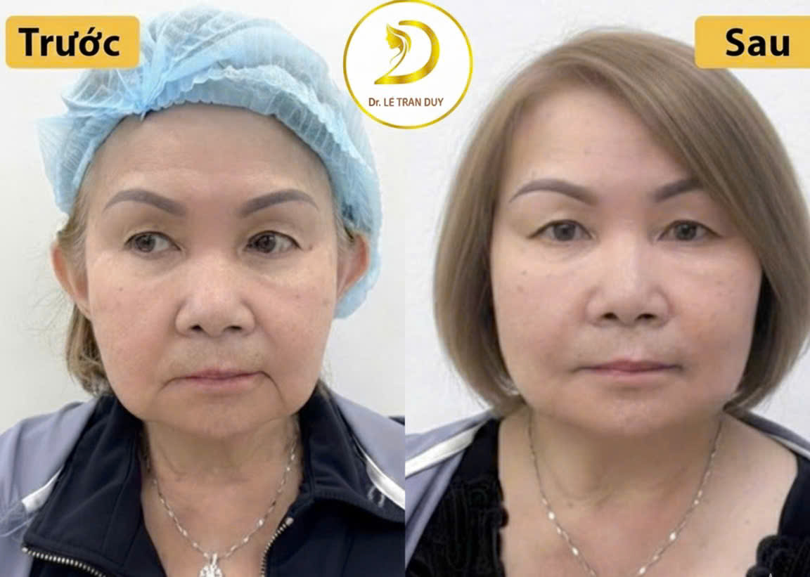 Căng da mặt tphcm