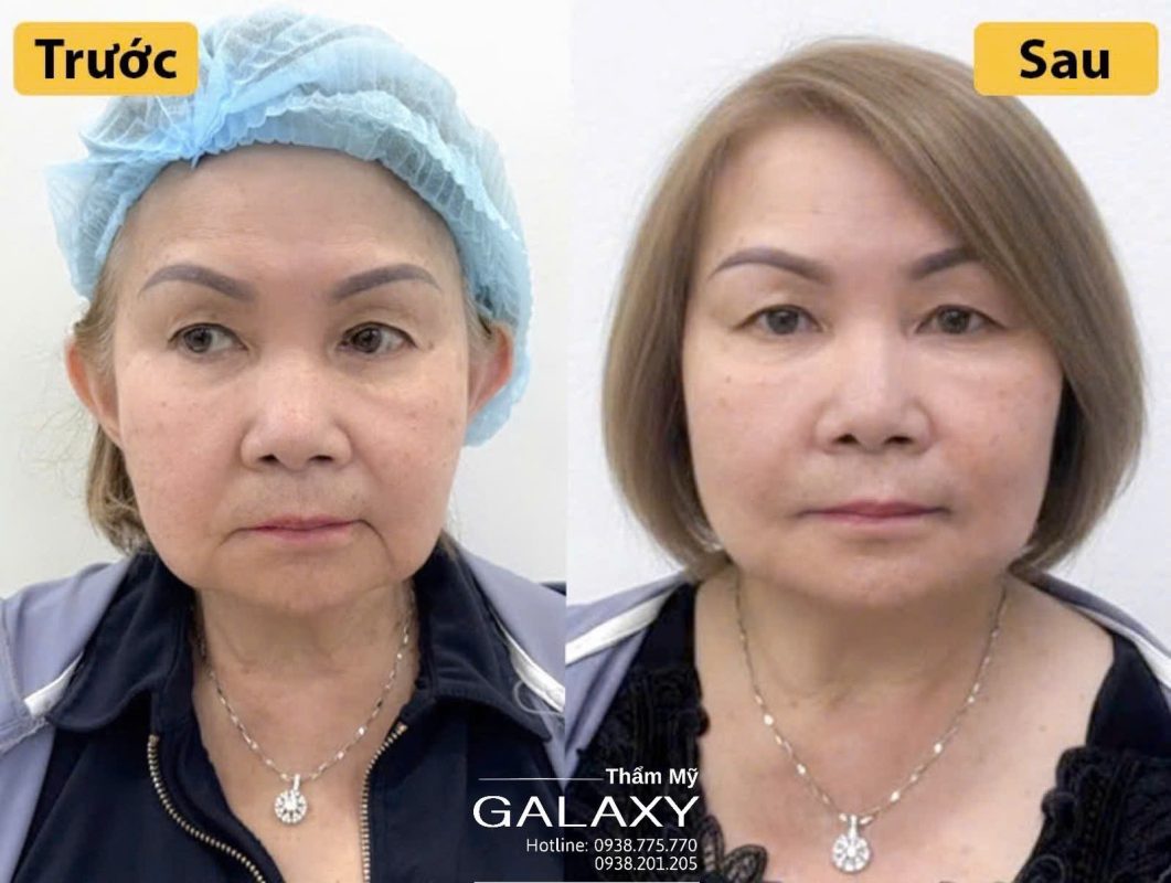 Căng da mặt mini ở đâu đẹp ?