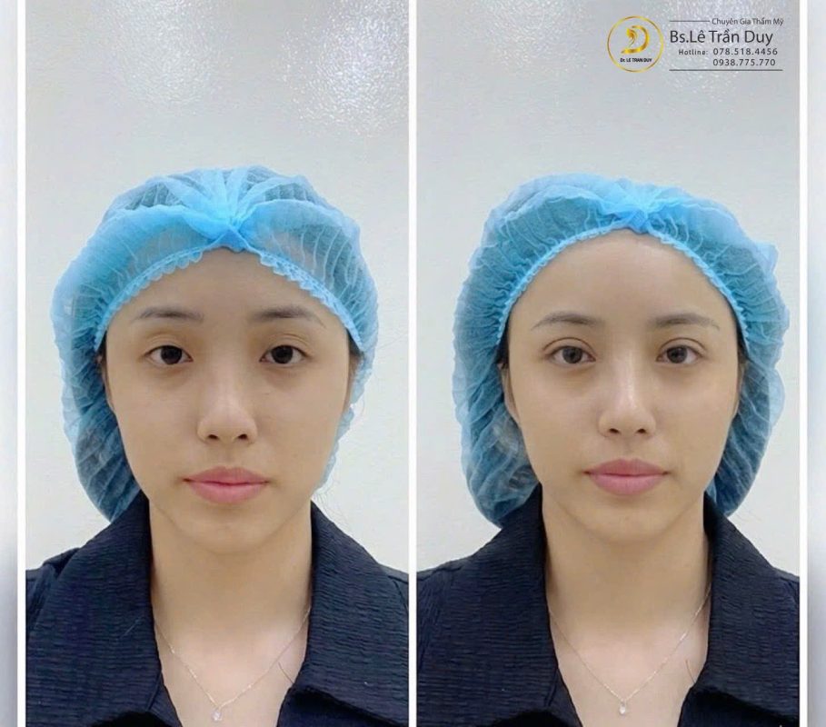 Nhấn mí mắt hcm